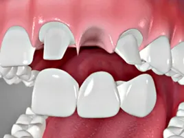 Dental Bridge