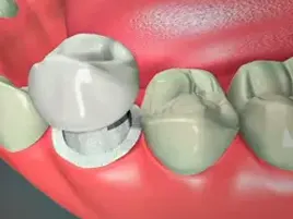 Dental Crown