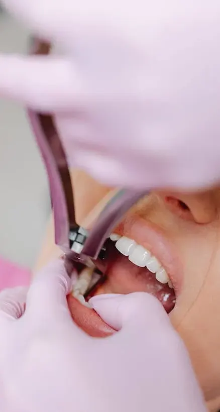 Procedure of Dental Extraction in Grand Prairie