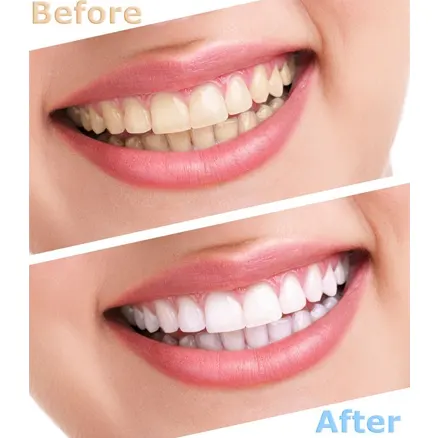 Before & After Images of Teeth Whitening in Grand Prairie