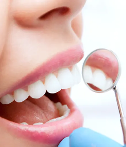 How Long Do Tooth-Colored Fillings Last?