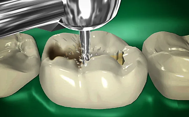 Tooth Colored Filling in Grand Prairie